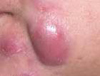 Cystic Acne